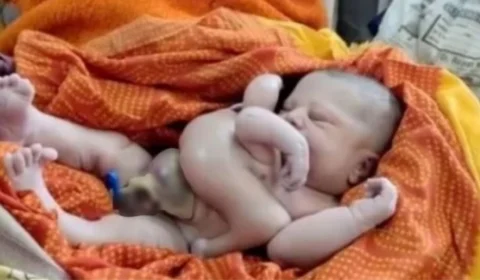 Na Índia, bebê nasce com quatro braços e quatro pernas e é endeusado