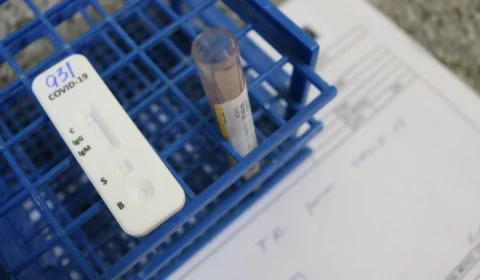 Flurona: AM tem mais 4 casos de coinfecção por Covid-19 e Influenza