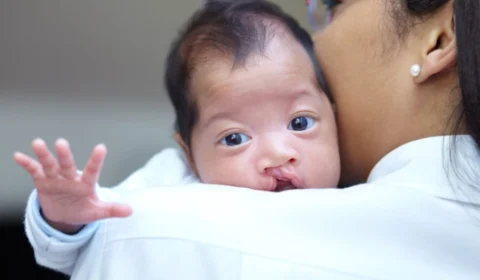 SUS deve oferecer cirurgia de lábio leporino e fenda palatina, segundo projeto aprovado por comissão no Senado