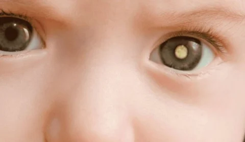 Retinoblastoma: saiba mais sobre o câncer ocular enfrentado pela bebê de 1 ano do apresentador Tiago Leifert