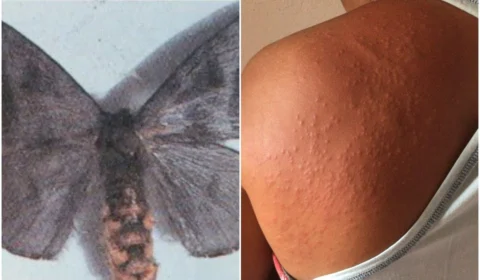 Mariposas são responsáveis por surto de coceira em Recife, diz Sociedade Brasileira de Dermatologia