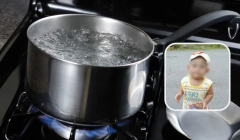 No Acre, bebê sofre queimadura de 2º grau após puxar panela de água quente de cima do fogão