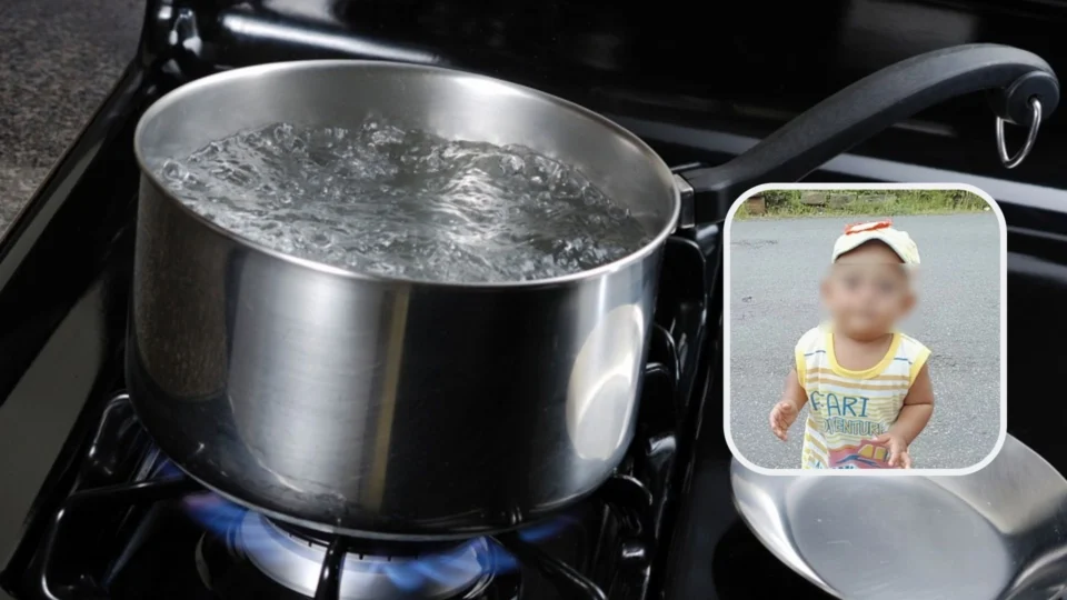 No Acre, bebê sofre queimadura de 2º grau após puxar panela de água quente de cima do fogão