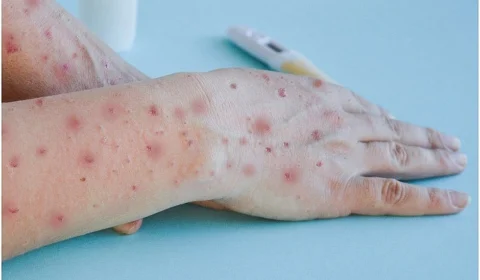 Sobe para 142 número de casos de Monkeypox no Brasil