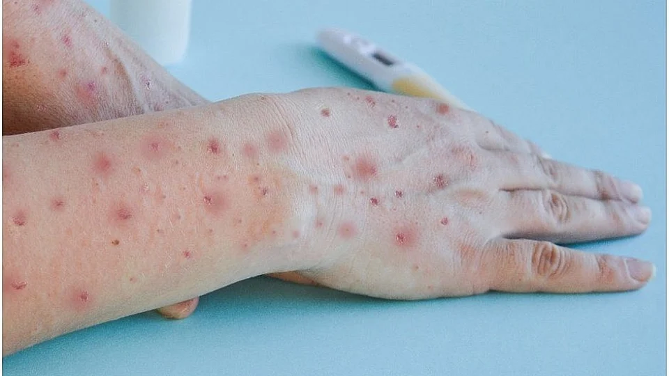 Sobe para 142 número de casos de Monkeypox no Brasil