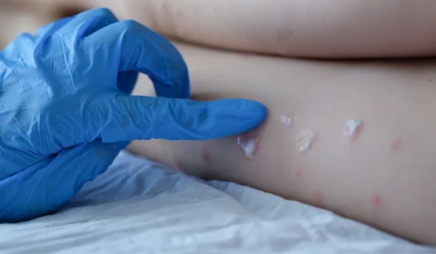 Monkeypox: sobe para 21 o número de infectados por varíola dos macacos no Amazonas