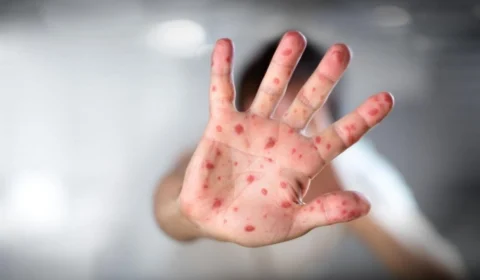 AM registra primeiro caso de sarampo em dois anos, diz FVS