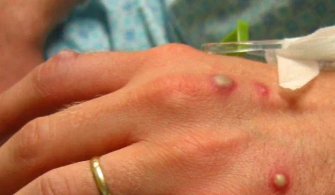 Ministério da Saúde confirma 9º caso de varíola dos macacos no país