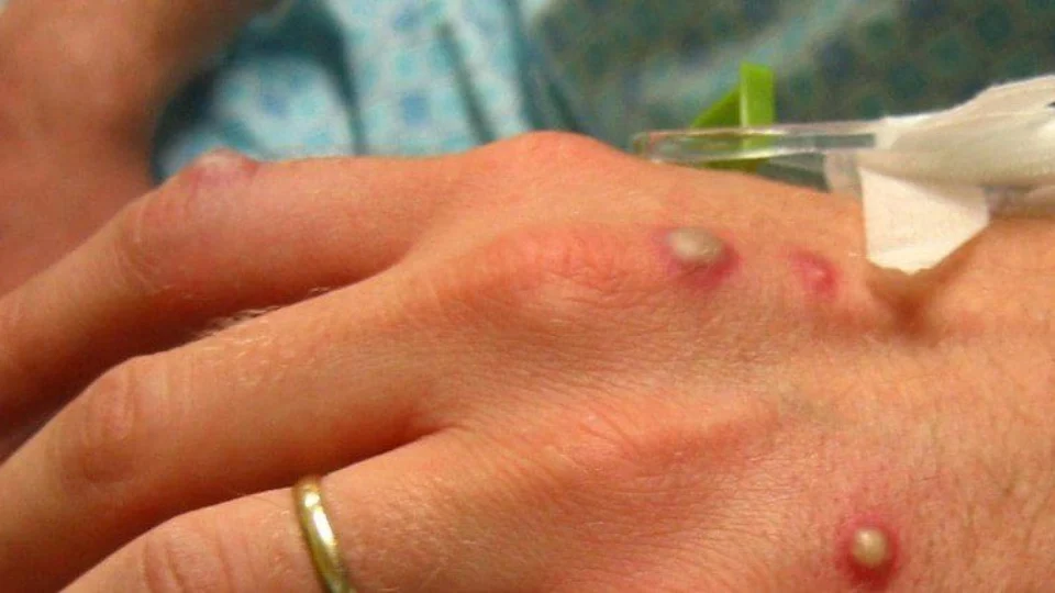 Ministério da Saúde confirma 9º caso de varíola dos macacos no país