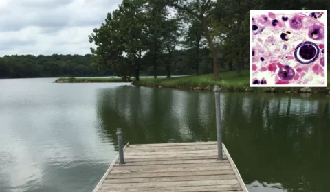 Nadador morre após ser infectado por ameba ‘comedora de cérebro’ em lago nos EUA