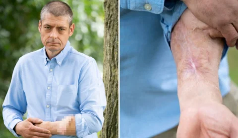 Homem fica com pênis anexado ao braço por 6 anos, na Inglaterra