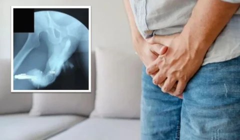 ‘Deformidade berinjela’: homem fratura órgão genital durante relação sexual na Indonésia