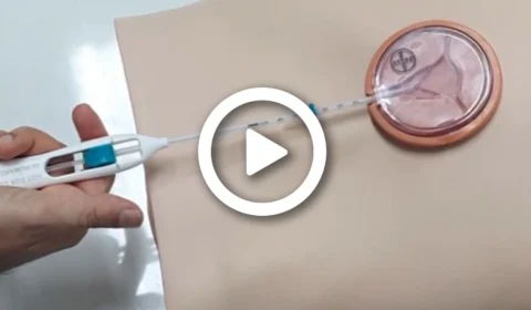 VÍDEO: cresce o número de procura por mulheres de Manaus pelo DIU