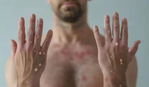 Brasil registra 76 casos confirmados de varíola dos macacos, diz MS