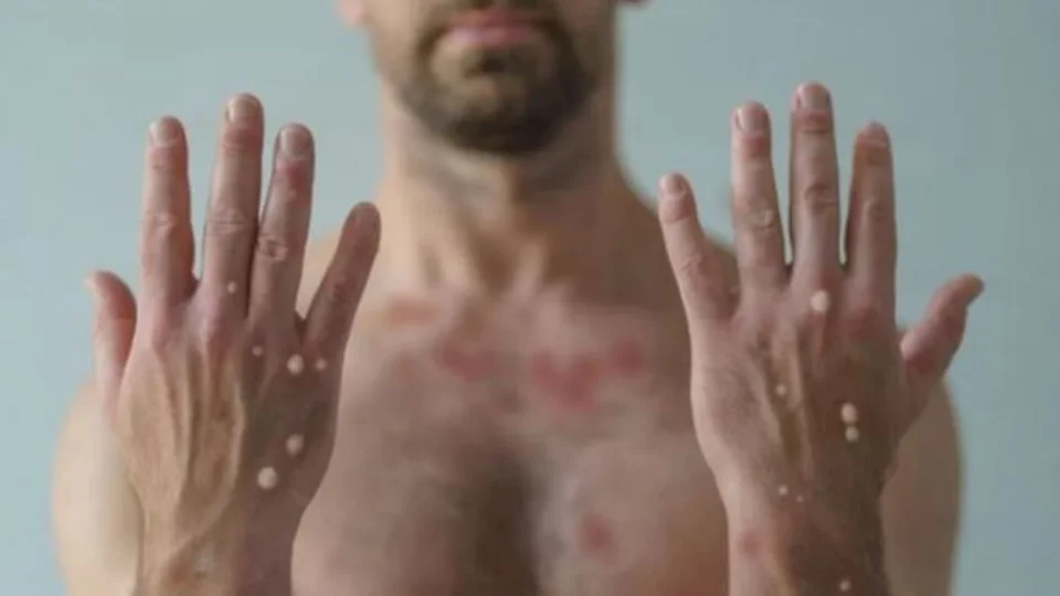 Brasil registra 76 casos confirmados de varíola dos macacos, diz MS