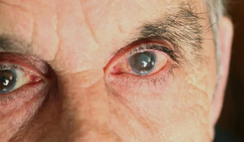 Catarata Senil: entenda sobre doença responsável por 47,8% dos casos de cegueira no mundo