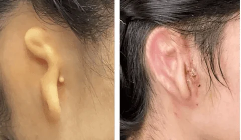 Cientistas fazem transplante de orelha usando impressão 3D de células, nos EUA