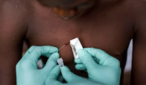 Israel confirma primeiro caso de varíola dos macacos