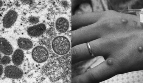 Varíola dos macacos se espalha pelo mundo e Alemanha registra primeiro caso em brasileiro