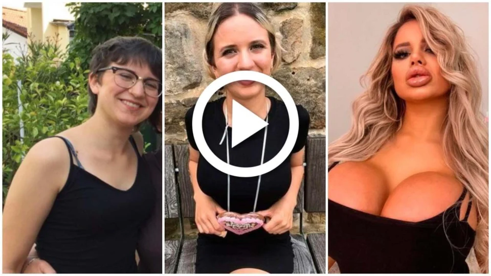 VÍDEO: modelo do Onlyfans mostra antes e depois de plásticas no valor de R$ 315 mil