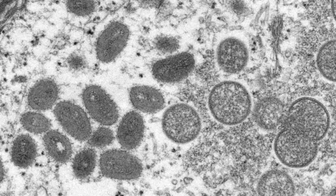 Brasil tem mais de 200 casos confirmados de varíola dos macacos