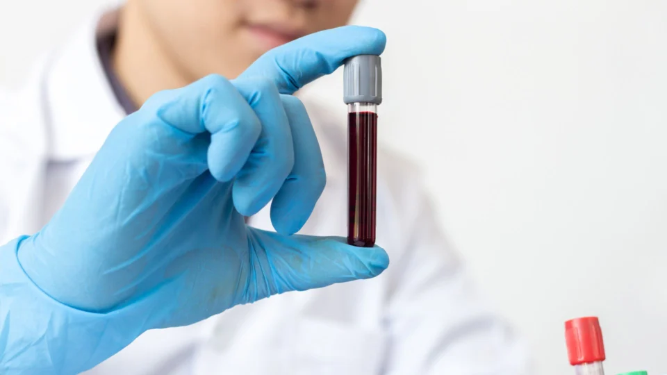 Monkeypox: sobe para 81 número de casos confirmados da varíola dos macacos no AM