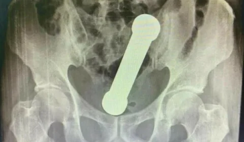 Homem é hospitalizado após procurar atendimento com peso de academia dentro do corpo, em Manaus