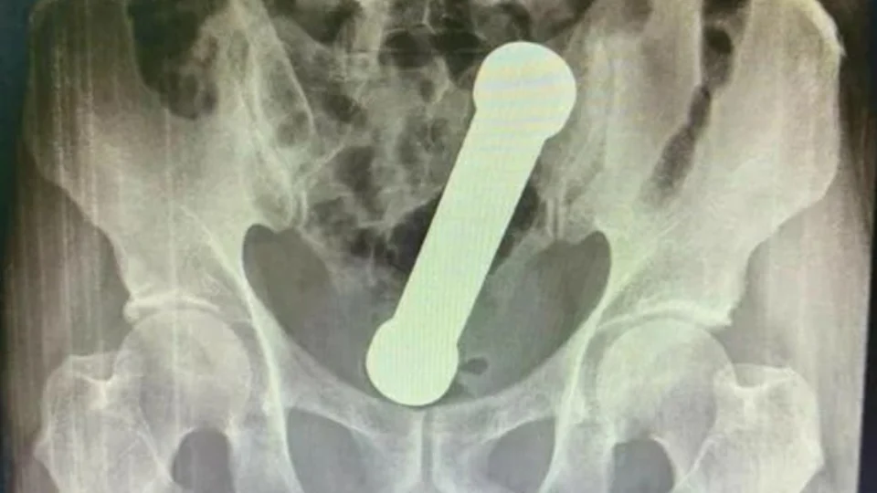 Homem é hospitalizado após procurar atendimento com peso de academia dentro do corpo, em Manaus