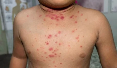 Brasil registra dois casos de varíola dos macacos em bebês