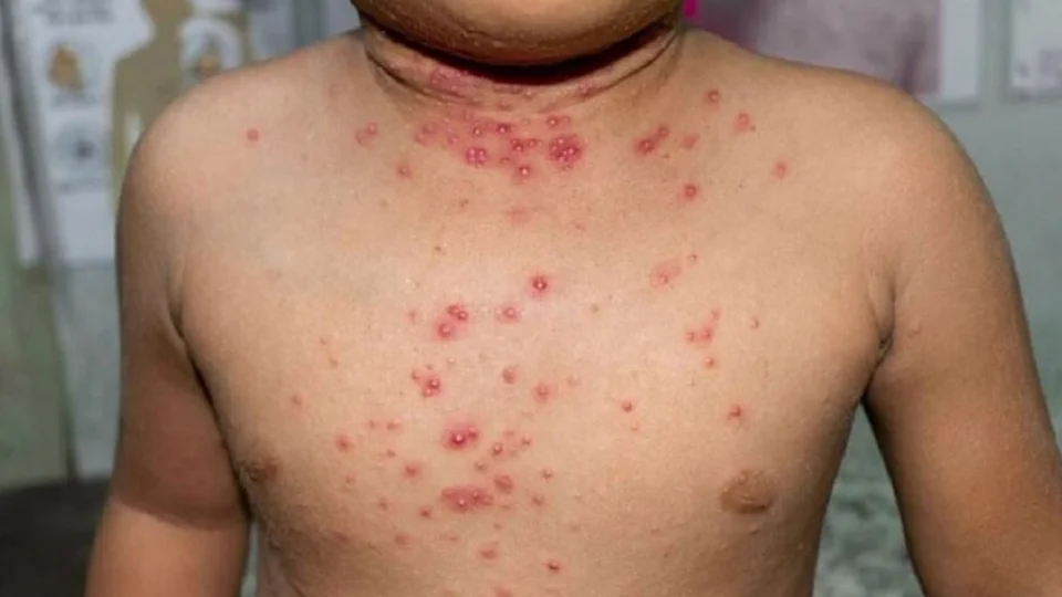 Brasil registra dois casos de varíola dos macacos em bebês