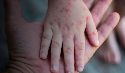 Projeto inclui imunizante contra varíola dos macacos no calendário nacional de vacinação