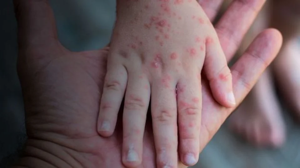 Projeto inclui imunizante contra varíola dos macacos no calendário nacional de vacinação