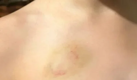 Advogado morde filha de 6 anos e ação vira caso de polícia em Brasília