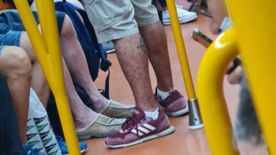 Médico flagra homem infectado com varíola dos macacos em metrô de Madri