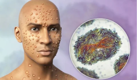 Varíola dos macacos: doença tem afetado principalmente homossexuais e bissexuais, diz OMS