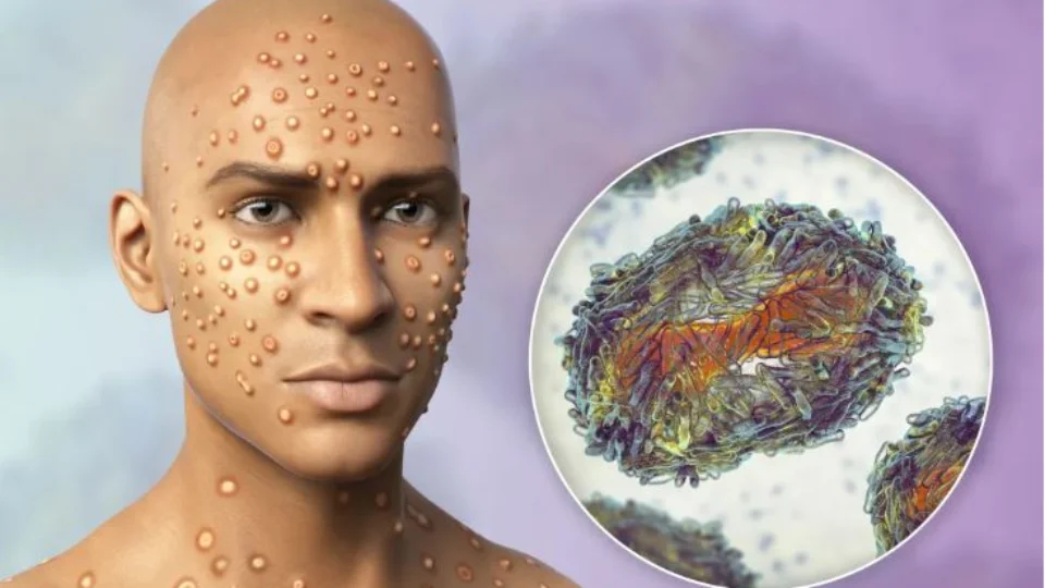 Varíola dos macacos: doença tem afetado principalmente homossexuais e bissexuais, diz OMS