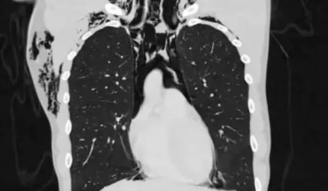 Jovem desenvolve problema pulmonar e é internado em UTI após ato de masturbação, na Suíça