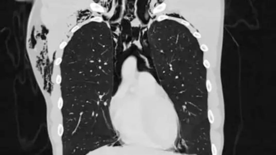 Jovem desenvolve problema pulmonar e é internado em UTI após ato de masturbação, na Suíça