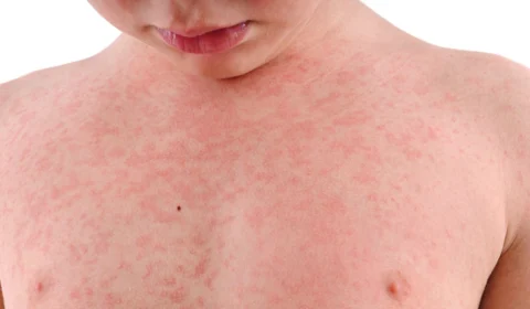 Confira lesões de pele mais comuns relacionadas a casos de Covid-19