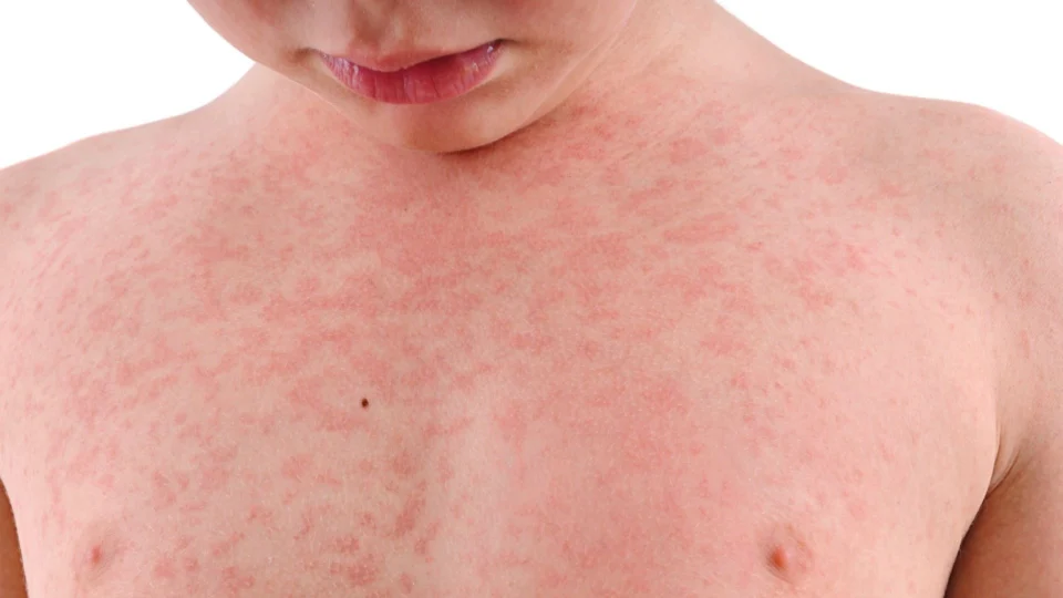 Confira lesões de pele mais comuns relacionadas a casos de Covid-19