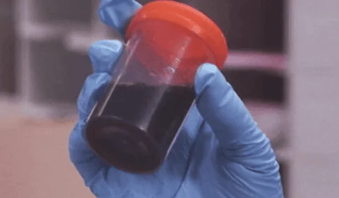 FVS-RCP investiga casos notificados da doença ‘da urina preta’ em Itacoatiara-AM