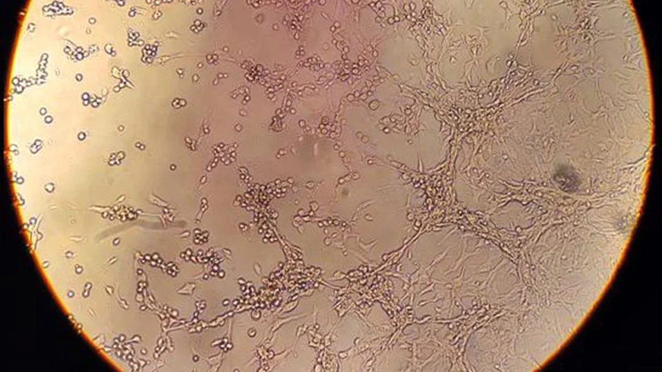 Monkeypox: AM contabiliza 208 casos confirmados e outros 69 em investigação