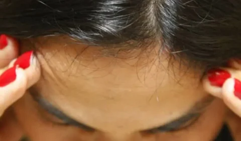 Enxaqueca constante pode ter relação com problemas bucais e faciais; entenda