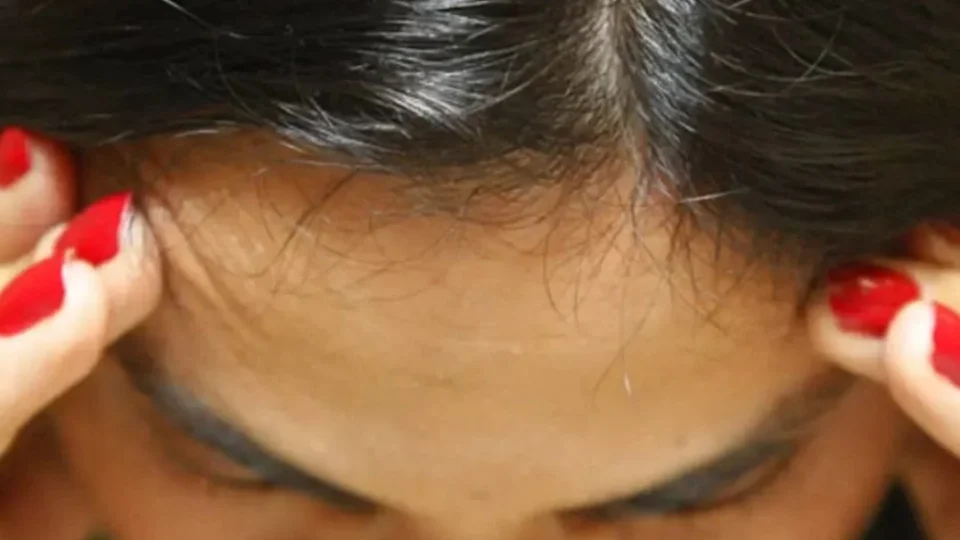 Enxaqueca constante pode ter relação com problemas bucais e faciais; entenda