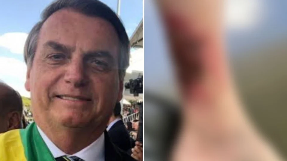 Carlos Bolsonaro diz que presidente está em recuperação de ferimento na perna