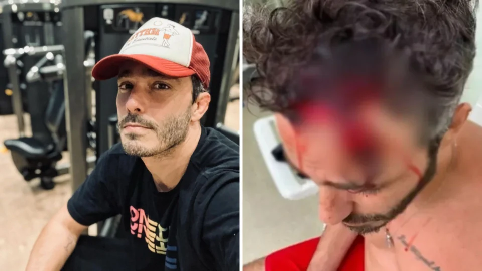 Thiago Rodrigues perde parte do couro cabeludo e está em choque, diz empresária