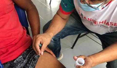 Hanseníase: Fuham faz mutirão para detectar doença no sábado, 28, em Manaus