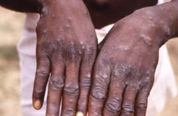 Mpox: Tocantins registrada 8 casos suspeito de varíola dos macacos