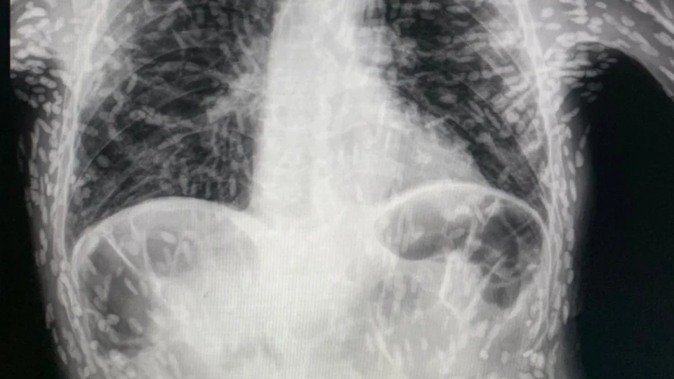 Médico divulga raio-x de paciente com tórax cheio de ‘ovos de verme’