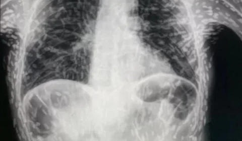 Tecnologia de empresa em SP faz diagnóstico de mesmo parasita revelado em tórax de paciente; conheça